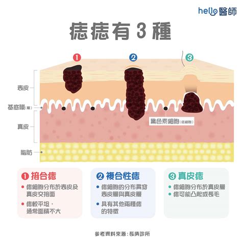 身體長誌|痣變大、痣多或長毛會變皮膚癌？認識痣的形成與原因